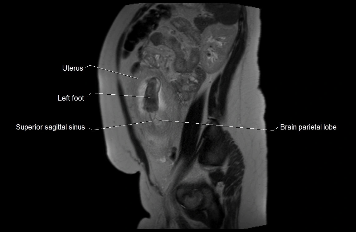 MRI fetal anatomy sagittal image 27.webp